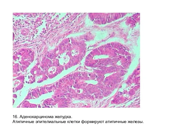 16. Аденокарцинома желудка. Атипичные эпителиальные клетки формируют атипичные железы.