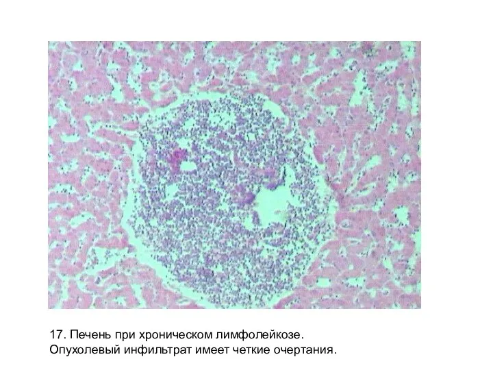 17. Печень при хроническом лимфолейкозе. Опухолевый инфильтрат имеет четкие очертания.