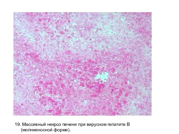 19. Массивный некроз печени при вирусном гепатите В (молниеносной форме).