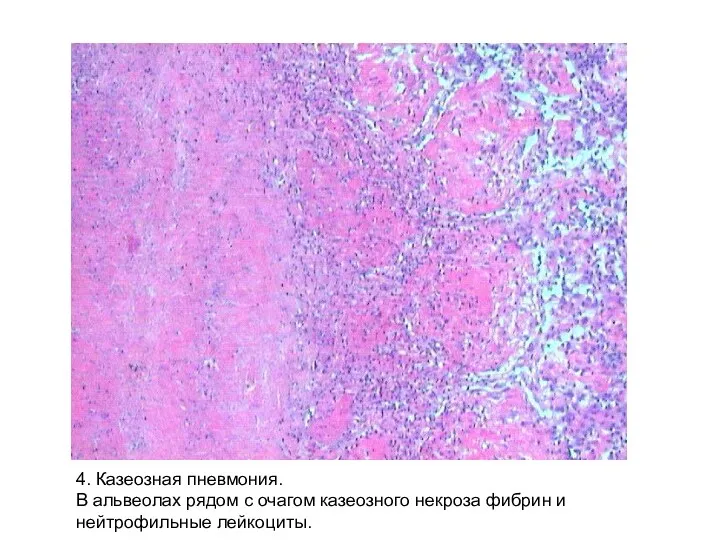 4. Казеозная пневмония. В альвеолах рядом с очагом казеозного некроза фибрин и нейтрофильные лейкоциты.