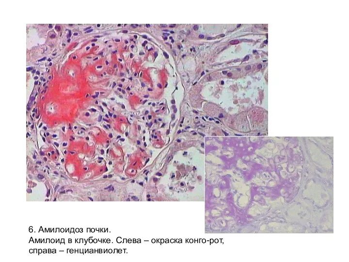 6. Амилоидоз почки. Амилоид в клубочке. Слева – окраска конго-рот, справа – генцианвиолет.
