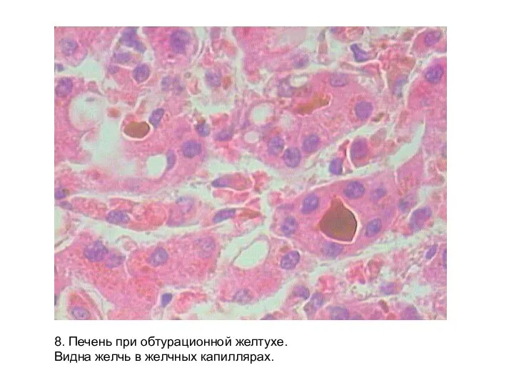 8. Печень при обтурационной желтухе. Видна желчь в желчных капиллярах.