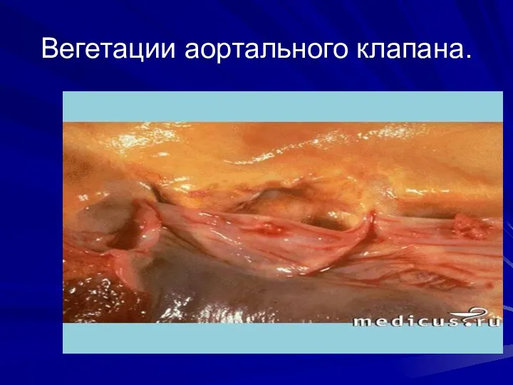 Вегетации аортального клапана.