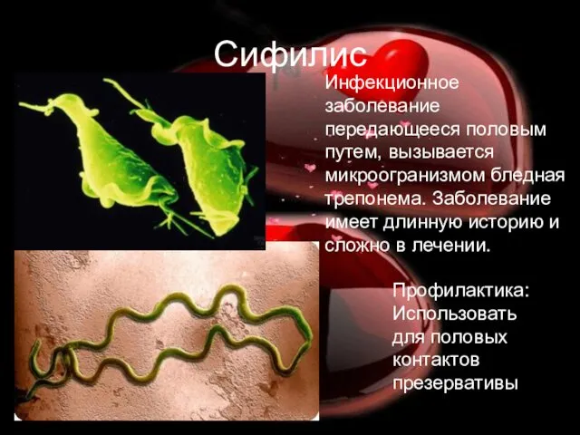 Сифилис Инфекционное заболевание передающееся половым путем, вызывается микроогранизмом бледная трепонема.