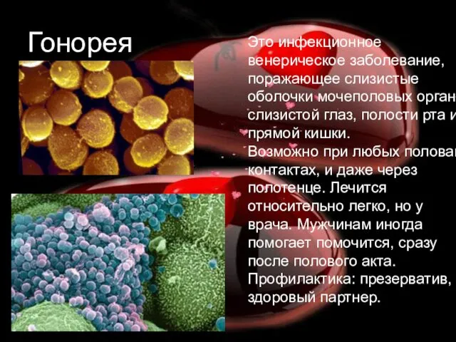 Гонорея Это инфекционное венерическое заболевание, поражающее слизистые оболочки мочеполовых органов,