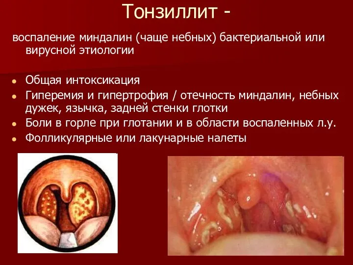 Тонзиллит - воспаление миндалин (чаще небных) бактериальной или вирусной этиологии Общая интоксикация Гиперемия