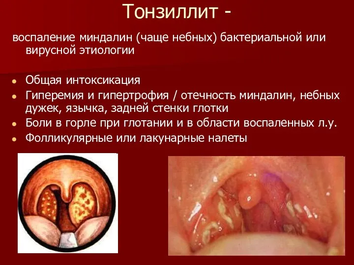 Тонзиллит - воспаление миндалин (чаще небных) бактериальной или вирусной этиологии