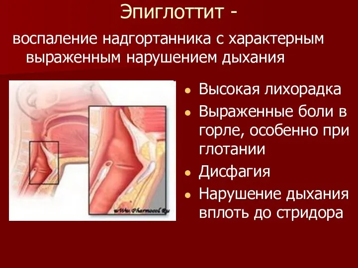 Эпиглоттит - воспаление надгортанника с характерным выраженным нарушением дыхания Высокая лихорадка Выраженные боли