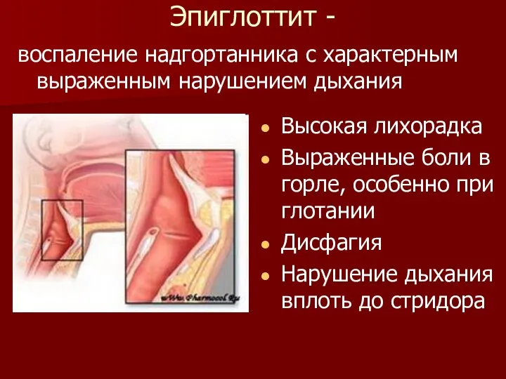 Эпиглоттит - воспаление надгортанника с характерным выраженным нарушением дыхания Высокая