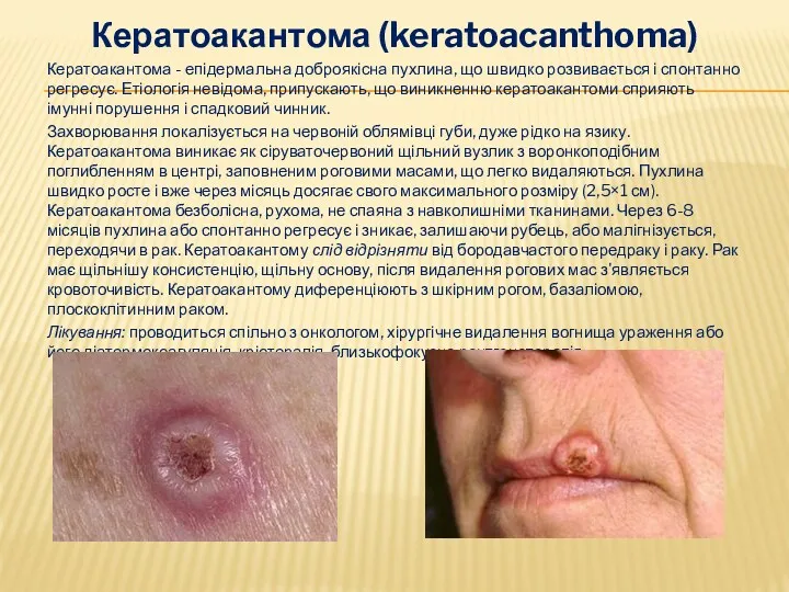 Кератоакантома (keratoacanthoma) Кератоакантома - епідермальна доброякісна пухлина, що швидко розвивається