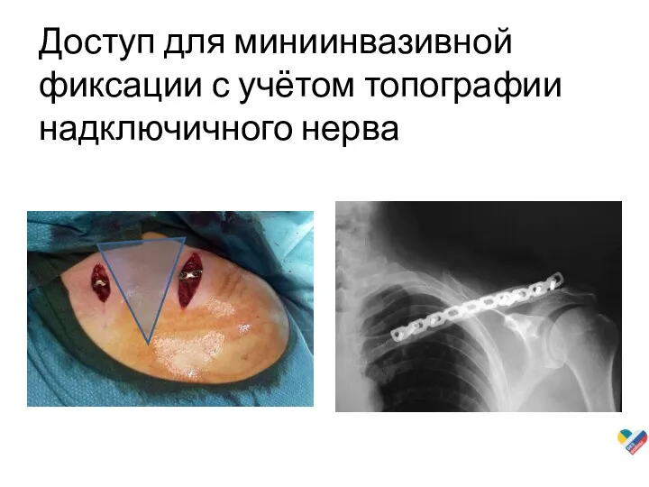 Доступ для миниинвазивной фиксации с учётом топографии надключичного нерва