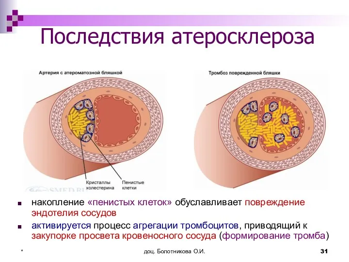 доц. Болотникова О.И. * Последствия атеросклероза накопление «пенистых клеток» обуславливает