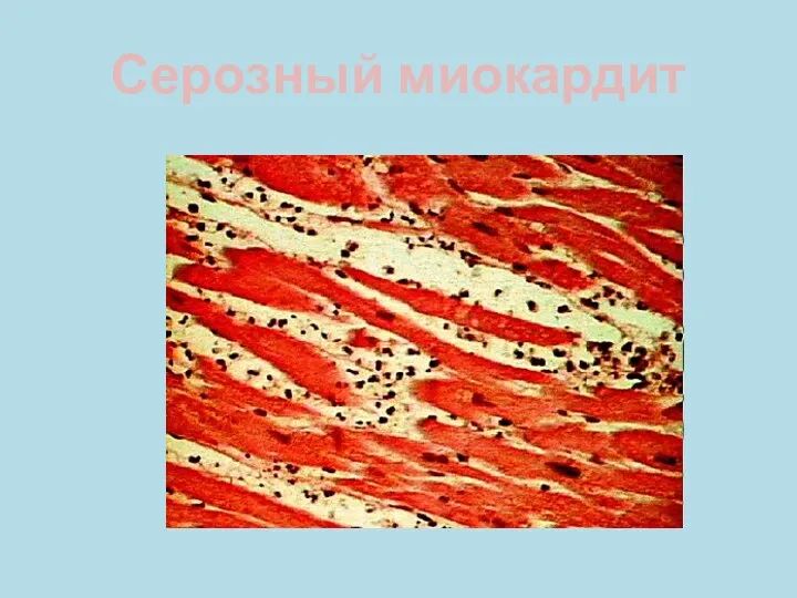 Серозный миокардит