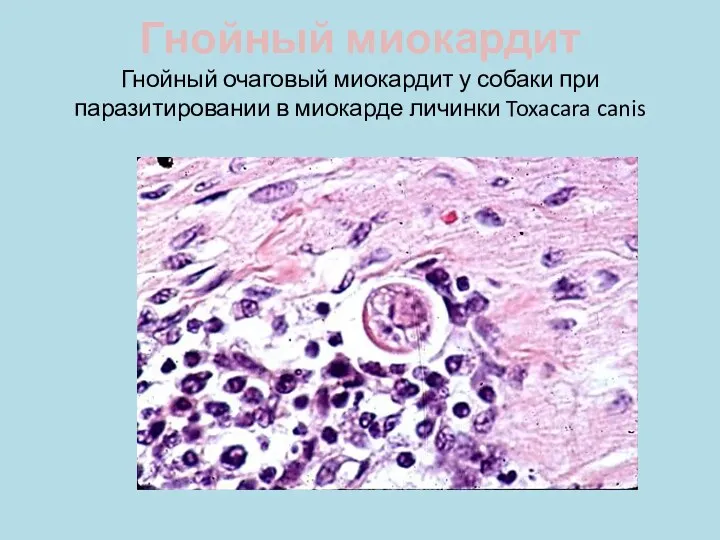 Гнойный миокардит Гнойный очаговый миокардит у собаки при паразитировании в миокарде личинки Toxacara canis