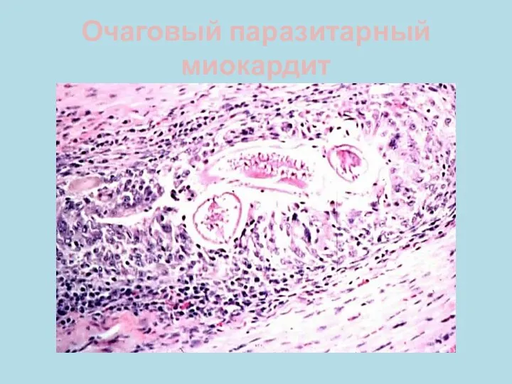 Очаговый паразитарный миокардит