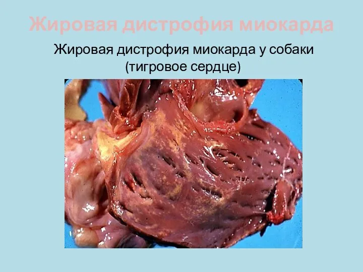 Жировая дистрофия миокарда Жировая дистрофия миокарда у собаки (тигровое сердце)