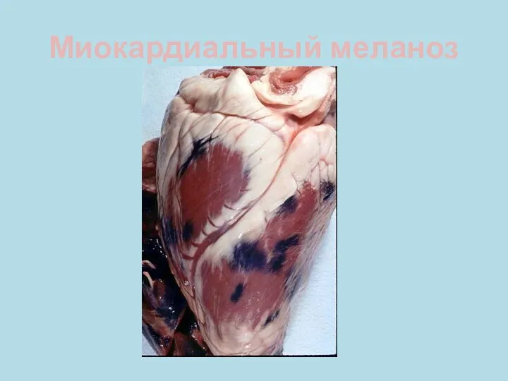 Миокардиальный меланоз
