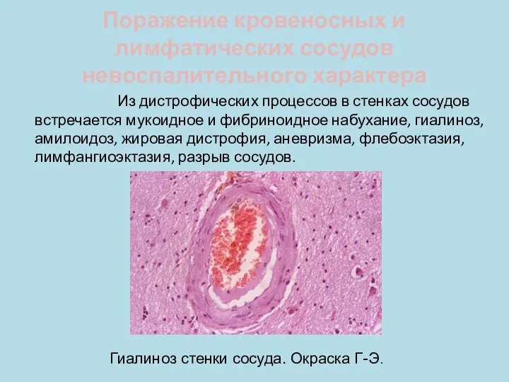 Поражение кровеносных и лимфатических сосудов невоспалительного характера Из дистрофических процессов