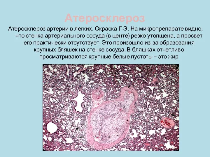 Атеросклероз Атеросклероз артерии в легких. Окраска Г-Э. На микропрепарате видно,