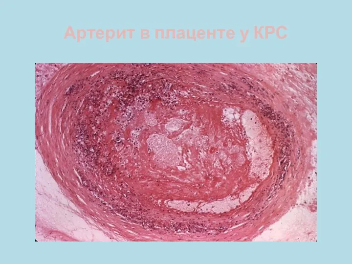 Артерит в плаценте у КРС