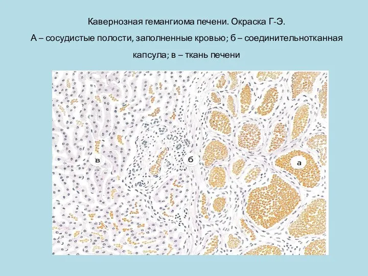 Кавернозная гемангиома печени. Окраска Г-Э. А – сосудистые полости, заполненные