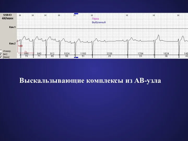 Выскальзывающие комплексы из АВ-узла