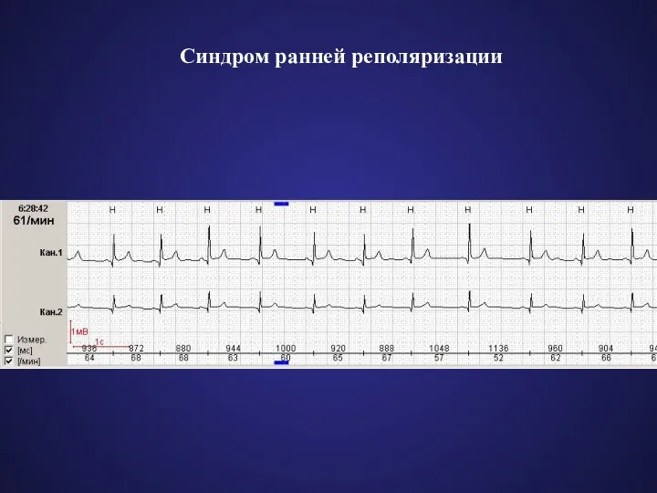 Синдром ранней реполяризации