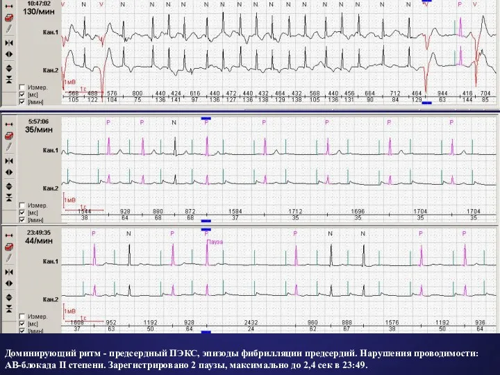 Доминирующий ритм - предсердный ПЭКС, эпизоды фибрилляции предсердий. Нарушения проводимости: