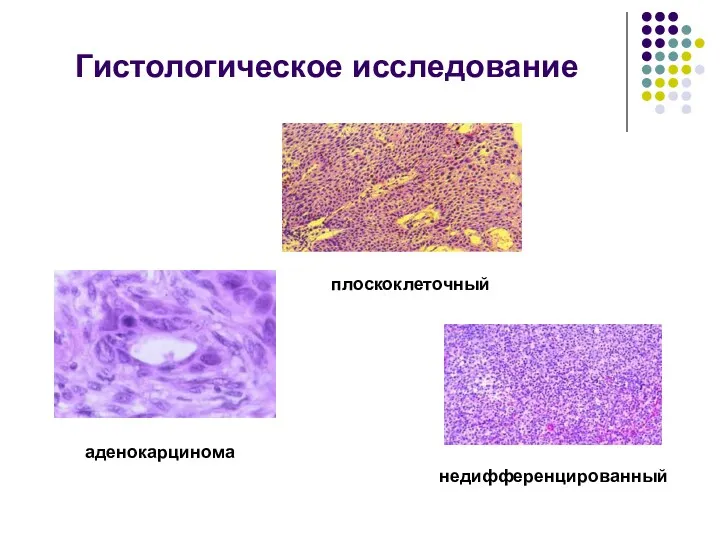 Гистологическое исследование аденокарцинома плоскоклеточный недифференцированный