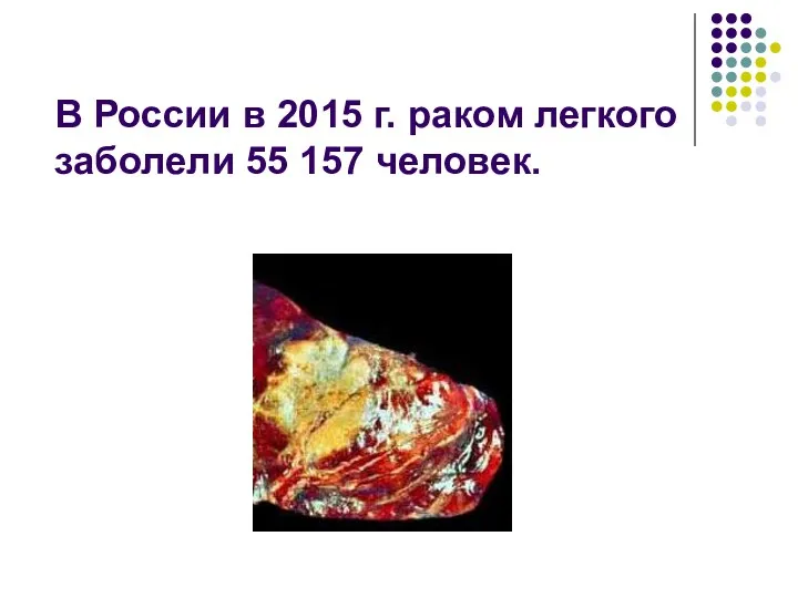 В России в 2015 г. раком легкого заболели 55 157 человек.