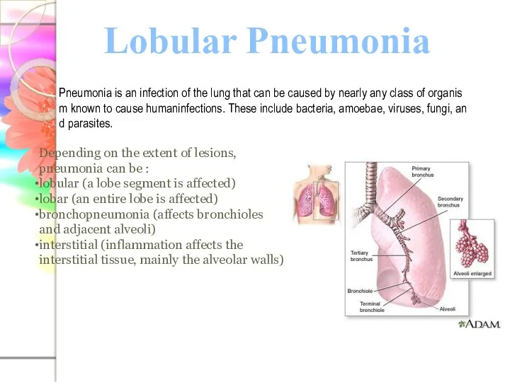 Lobular Pneumonia Pneumonia is an infection of the lung that