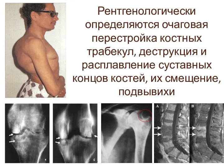 Рентгенологически определяются очаговая перестройка костных трабекул, деструкция и расплавление суставных концов костей, их смещение, подвывихи