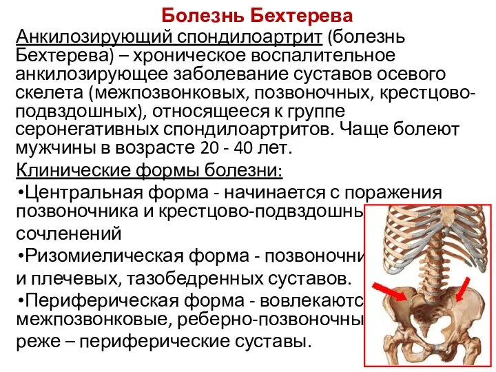 Болезнь Бехтерева Анкилозирующий спондилоартрит (болезнь Бехтерева) – хроническое воспалительное анкилозирующее