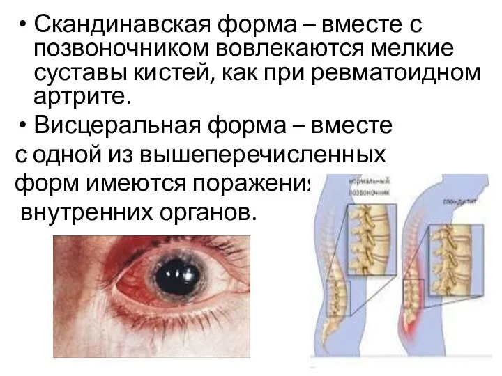 Скандинавская форма – вместе с позвоночником вовлекаются мелкие суставы кистей,