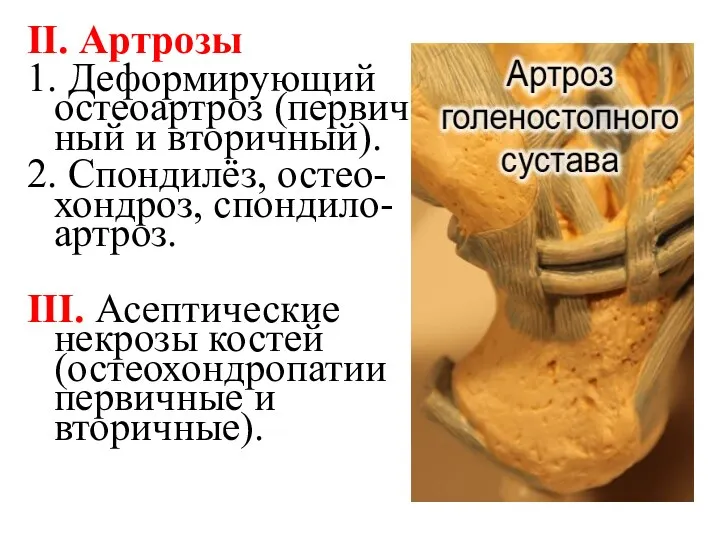II. Артрозы 1. Деформирующий остеоартроз (первич-ный и вторичный). 2. Спондилёз,