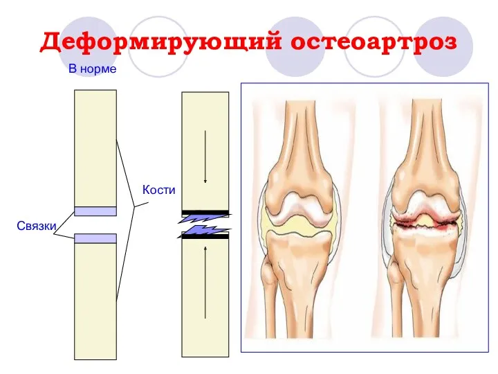 Деформирующий остеоартроз