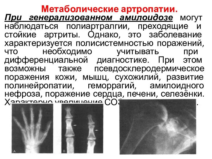 Метаболические артропатии. При генерализованном амилоидозе могут наблюдаться полиартралгии, преходящие и