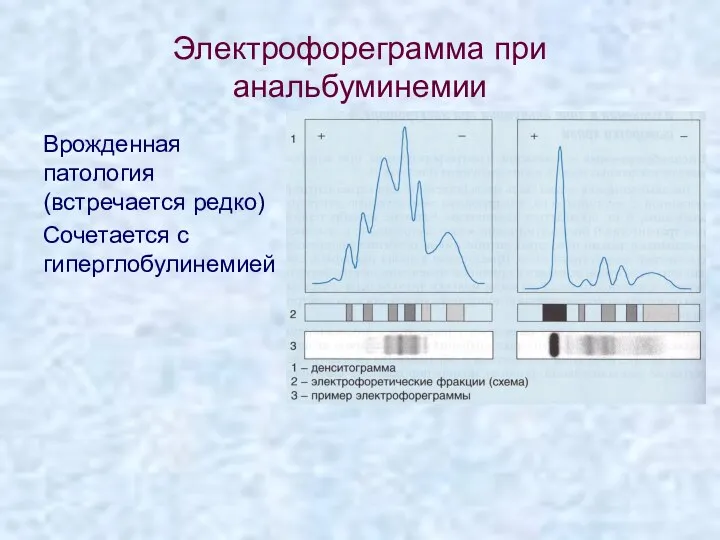 Электрофореграмма при анальбуминемии