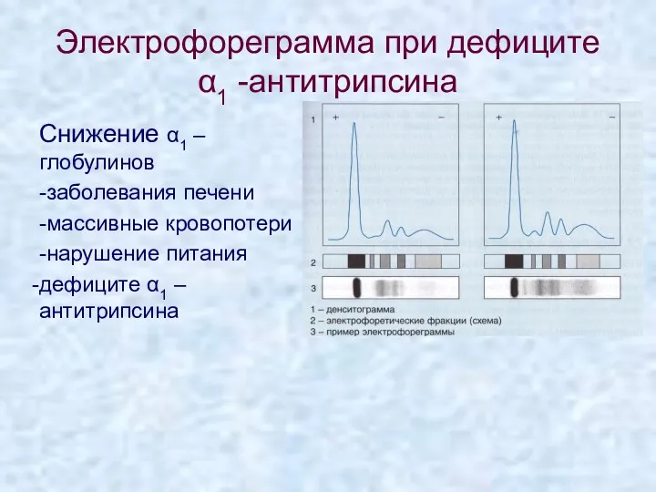 Электрофореграмма при дефиците α1 -антитрипсина