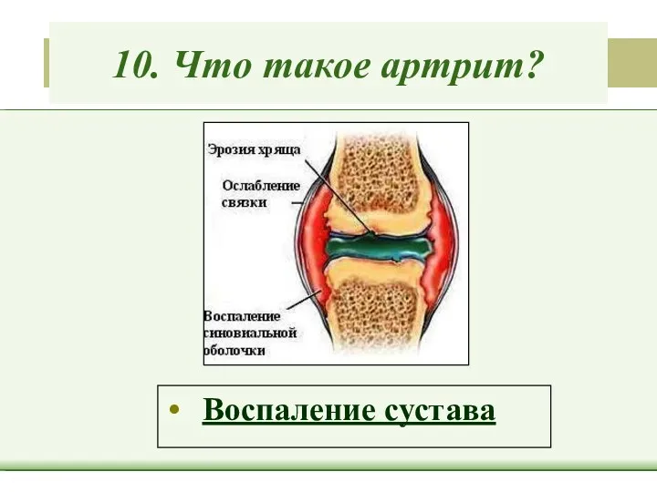 10. Что такое артрит? Воспаление сустава