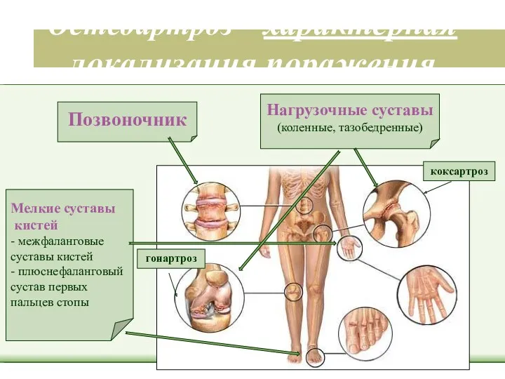 Остеоартроз – характерная локализация поражения Позвоночник Нагрузочные суставы (коленные, тазобедренные)