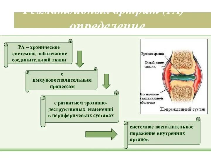 Ревматоидный артрит (РА) - определение РА – хроническое системное заболевание