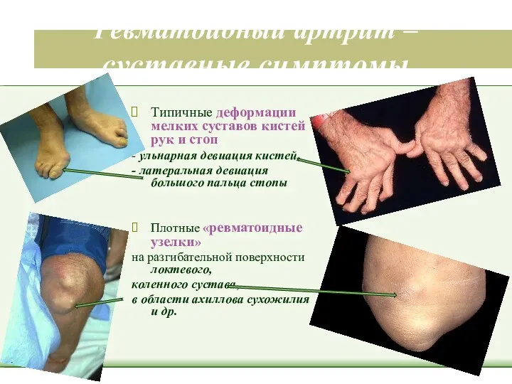 Ревматоидный артрит – суставные симптомы Типичные деформации мелких суставов кистей