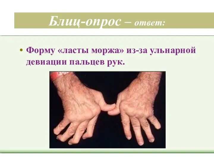 Блиц-опрос – ответ: Форму «ласты моржа» из-за ульнарной девиации пальцев рук.