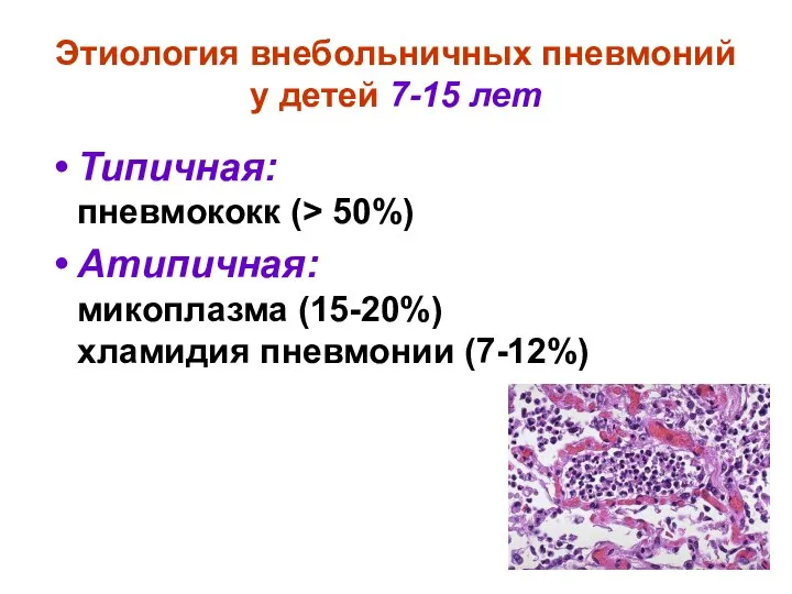 Этиология внебольничных пневмоний у детей 7-15 лет Типичная: пневмококк (> 50%) Атипичная: микоплазма