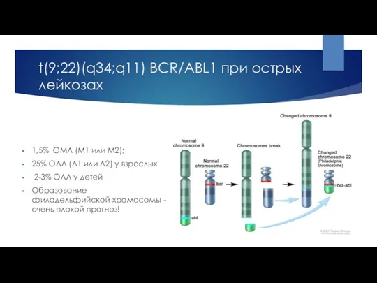 t(9;22)(q34;q11) BCR/ABL1 при острых лейкозах 1,5% ОМЛ (M1 или M2); 25% ОЛЛ (Л1