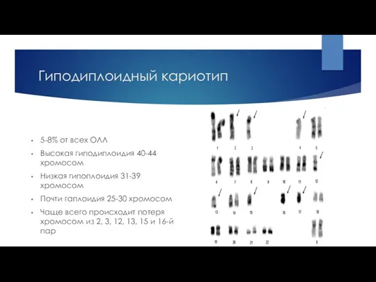 Гиподиплоидный кариотип 5-8% от всех ОЛЛ Высокая гиподиплоидия 40-44 хромосом Низкая гипоплоидия 31-39