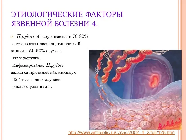 ЭТИОЛОГИЧЕСКИЕ ФАКТОРЫ ЯЗВЕННОЙ БОЛЕЗНИ 4. H.pylori обнаруживается в 70-80% случаев