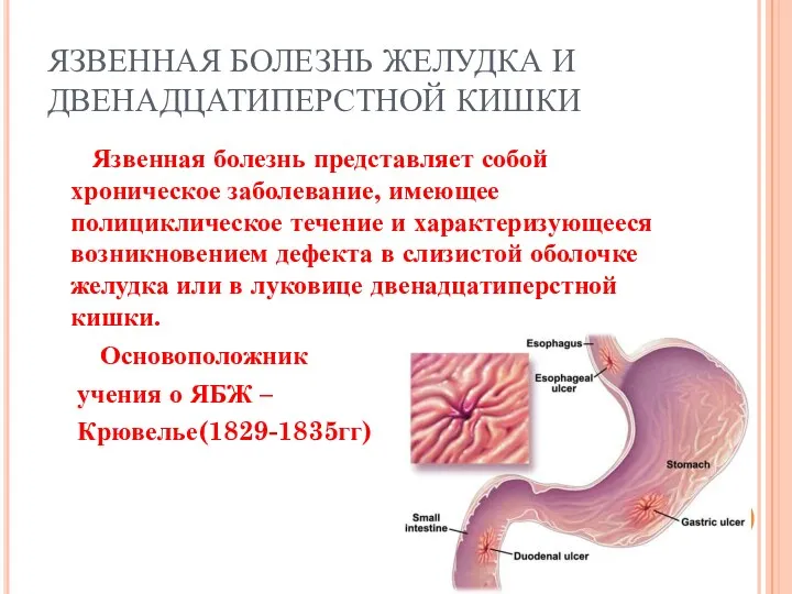 ЯЗВЕННАЯ БОЛЕЗНЬ ЖЕЛУДКА И ДВЕНАДЦАТИПЕРСТНОЙ КИШКИ Язвенная болезнь представляет собой