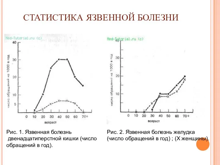 СТАТИСТИКА ЯЗВЕННОЙ БОЛЕЗНИ Рис. 1. Язвенная болезнь двенадцатиперстной кишки (число